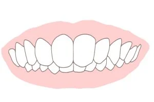 噛み合わせが深い