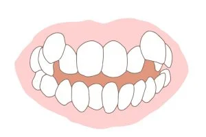 デコボコの歯の（叢生）